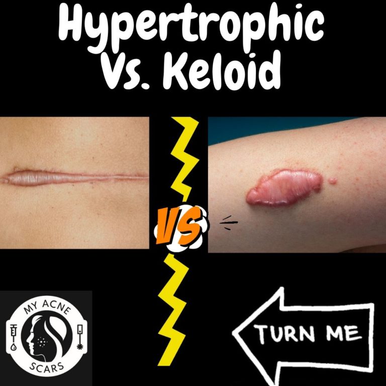 Hypertrophic Vs Keloid Scarring My Acne Scars