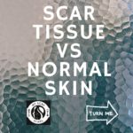 Scar Tissue Vs Normal Skin 14 1 2