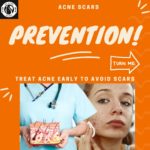 Prevent Acne Scars 9 1 3