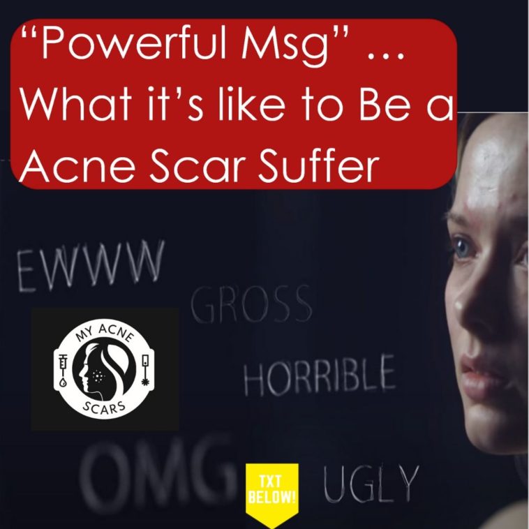 What It's Like to Have Acne Scars / Acne - Powerful Message 1 1 1