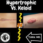 Hypertrophic Vs Keloid Scarring 8 1 6