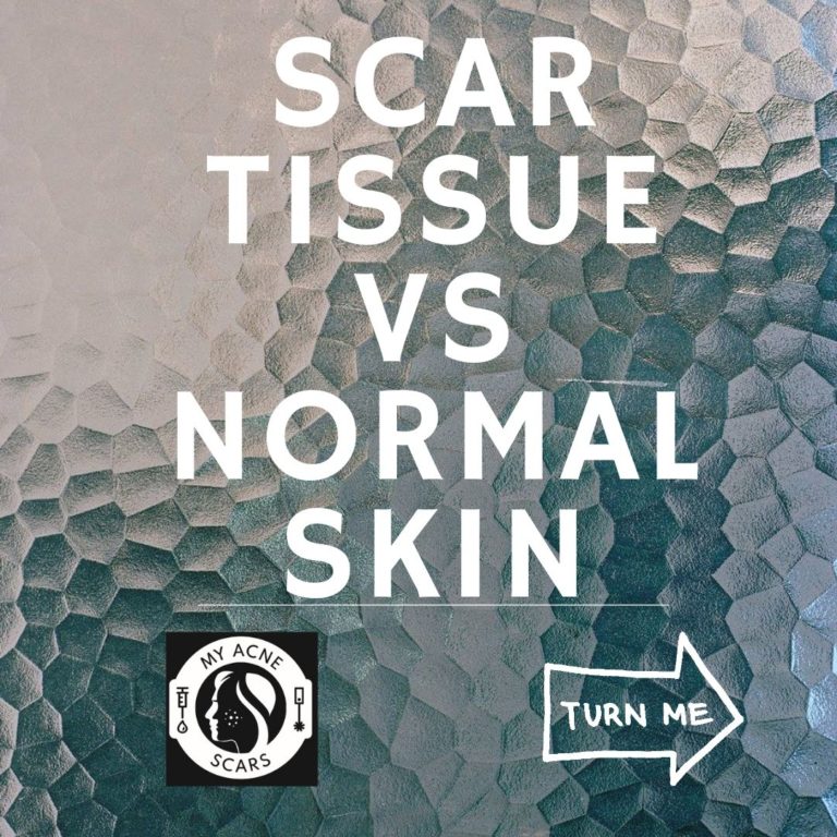 Scar Tissue Vs Normal Skin My Acne Scars