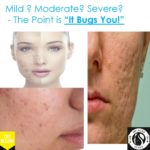 Severe - Moderate - Mild Acne Scars: The Point is it Bugs You! 2 2