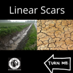 Linear Acne Scars: A Overview 8 1 10