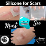 Using Silicone For Acne Scar and Redness (Patches, Liquids, Primers) 8 1 5