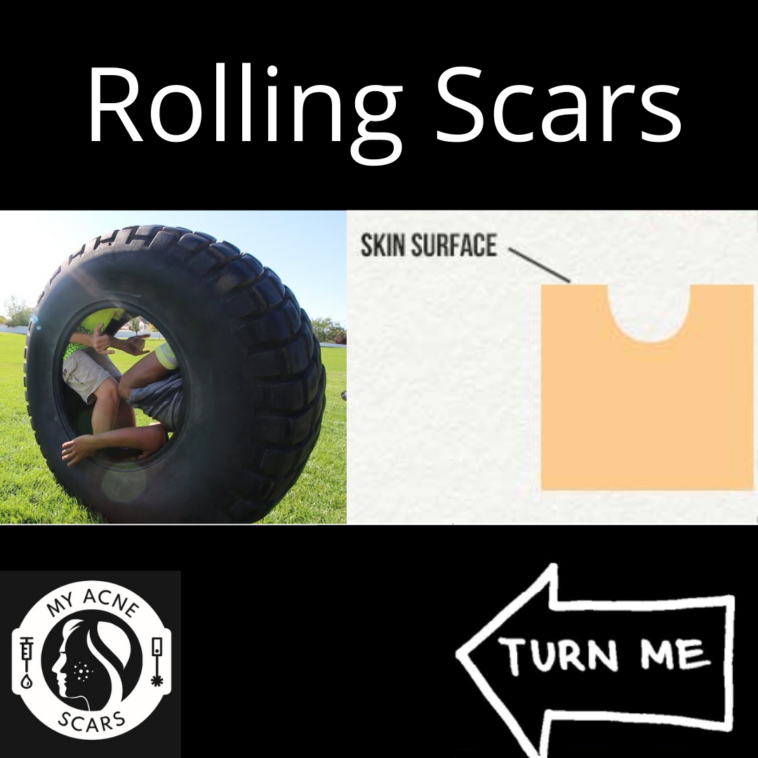Rolling Acne Scars: Overview 1 1 7