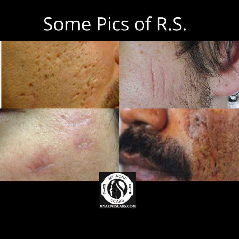 Linear Acne Scars A Overview My Acne Scars