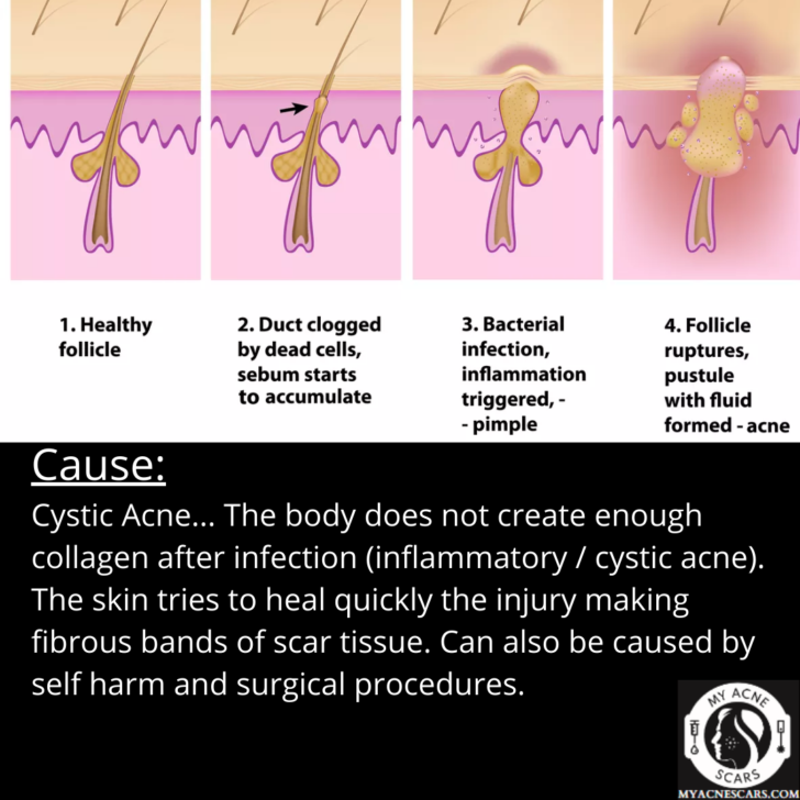 Linear Acne Scars: A Overview - My Acne Scars