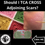 TCA CROSS Used On Adjoining Acne Scars or Pores? 6 Cross Adjoining Scars