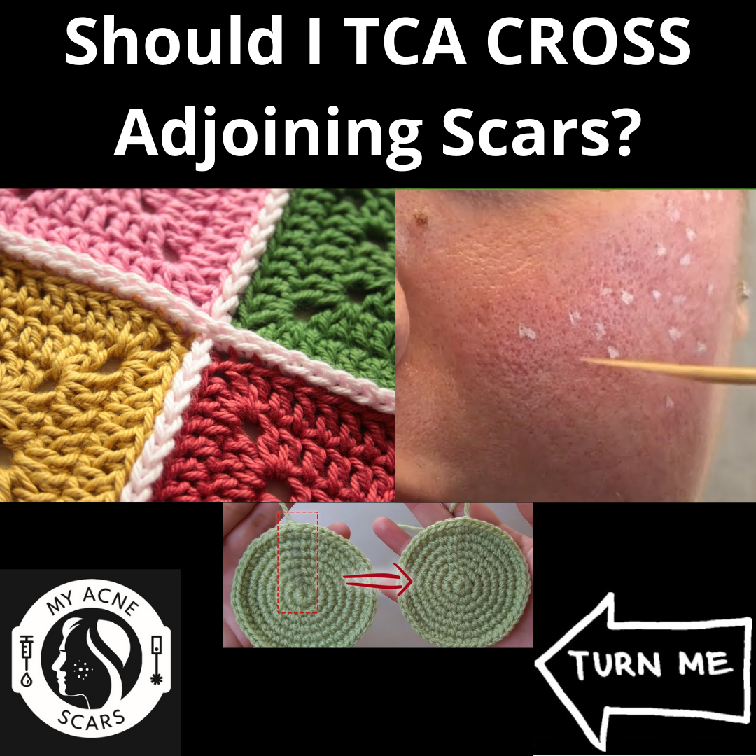 Tca Cross Used On Adjoining Acne Scars Or Pores My Acne Scars