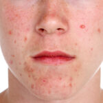 COVID 19 Effects on Acne Scar Patients and Not Receiving the Care And Attention They Need. 10 acne