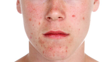 acne