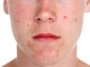acne