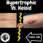 Hypertrophic Vs Keloid Scarring 2 1 6