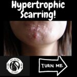 Hypertrophic Scarring 2 1 8