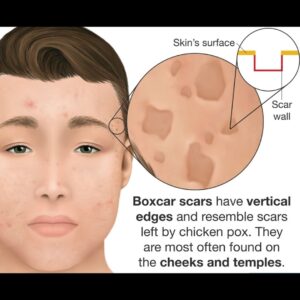 Boxcar Acne Scars - A Overview - My Acne Scars