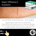 Hypertrophic Vs Keloid Scarring 3 2 6