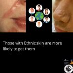 Hypertrophic Scarring 4 3 7