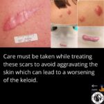 Hypertrophic Scarring 5 4 6