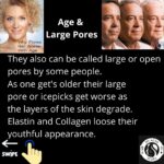 Icepick Acne Scars - A Overview 6 5 3