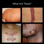 Hypertrophic Vs Keloid Scarring 6 5 4