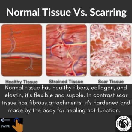 Scar Tissue Vs Normal Skin - My Acne Scars