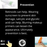 Icepick Acne Scars - A Overview 8 7 3