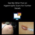 Hypertrophic Vs Keloid Scarring 8 7 4