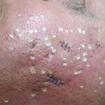 The Side Effects Of TCA CROSS for Acne Scars. 11 download 4